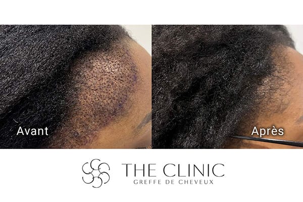 avant apres fue punch hyvride greffe de cheveux implants cheveux the clinic bruxelles expert implants capillaire greffe de cheveux france bruxelles 111