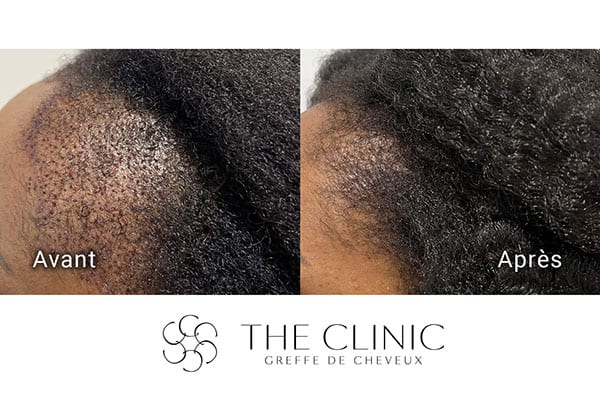 avant apres fue punch hyvride greffe de cheveux implants cheveux the clinic bruxelles expert implants capillaire greffe de cheveux france bruxelles 112