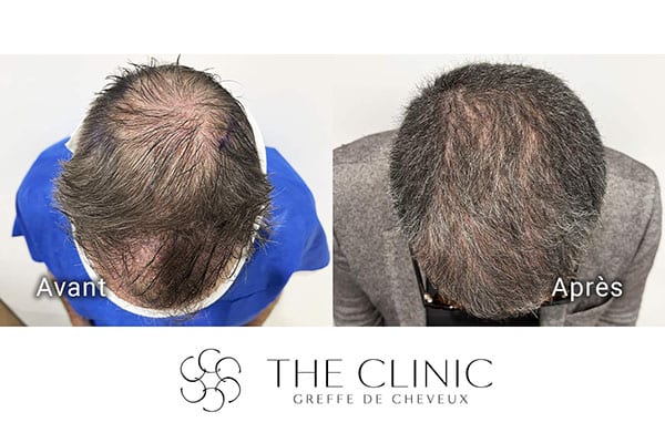avant apres fue punch hyvride greffe de cheveux implants cheveux the clinic bruxelles expert implants capillaire greffe de cheveux france bruxelles 113