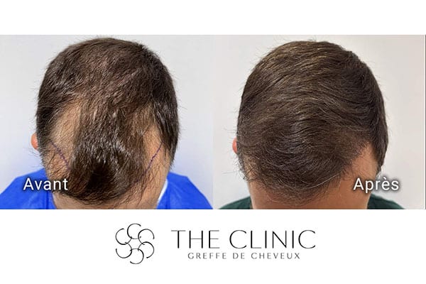 avant apres fue punch hyvride greffe de cheveux implants cheveux the clinic bruxelles expert implants capillaire greffe de cheveux france bruxelles 114