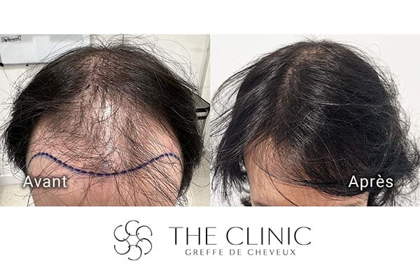 avant apres fue punch hyvride greffe de cheveux implants cheveux the clinic bruxelles expert implants capillaire greffe de cheveux france bruxelles 115