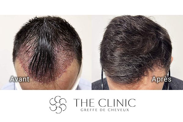 avant apres fue punch hyvride greffe de cheveux implants cheveux the clinic bruxelles expert implants capillaire greffe de cheveux france bruxelles 116