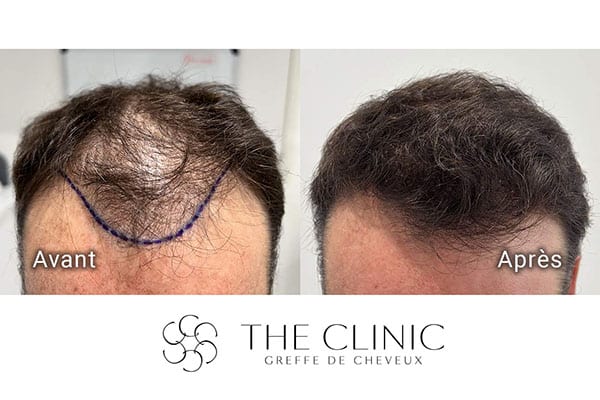 avant apres fue punch hyvride greffe de cheveux implants cheveux the clinic bruxelles expert implants capillaire greffe de cheveux france bruxelles 117