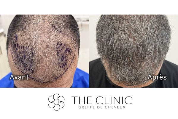 avant apres fue punch hyvride greffe de cheveux implants cheveux the clinic bruxelles expert implants capillaire greffe de cheveux france bruxelles 118
