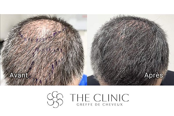 avant apres fue punch hyvride greffe de cheveux implants cheveux the clinic bruxelles expert implants capillaire greffe de cheveux france bruxelles 119