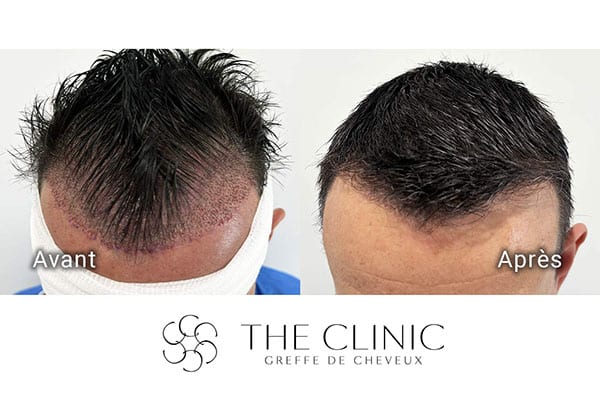 avant apres fue punch hyvride greffe de cheveux implants cheveux the clinic bruxelles expert implants capillaire greffe de cheveux france bruxelles 120